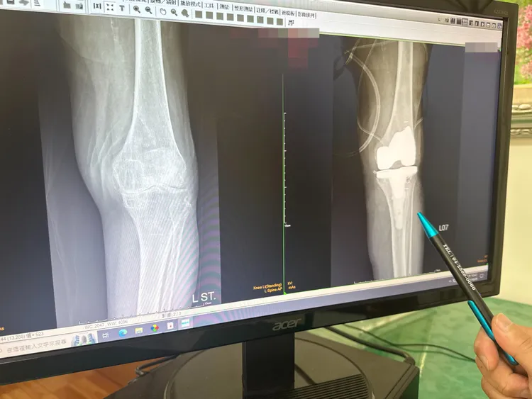 百歲人瑞左膝關節退化，置換人工關節(右)。院方提供