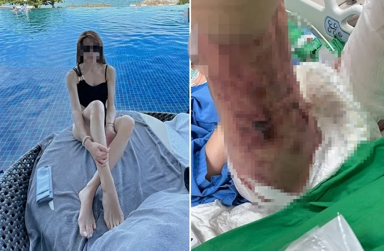 林女本來身體相當健康，也有修長美腿，卻因腎功能衰竭併發雙腿長出血泡。資料照片