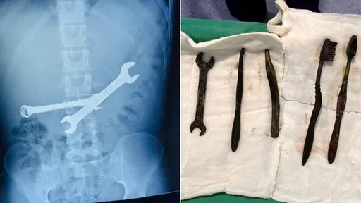 26岁男胃痛　竟是吃了2把扳手7支牙刷