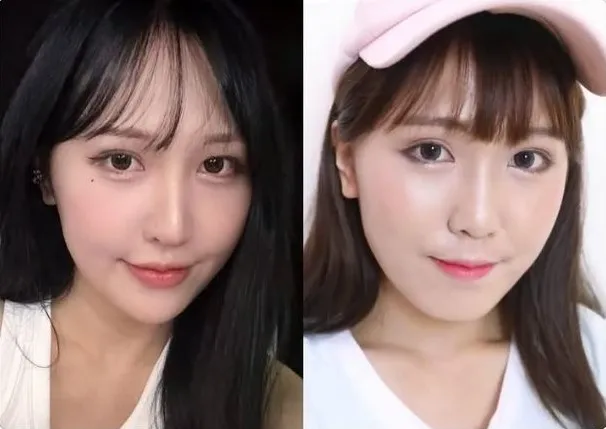 萧伊下巴打玻尿酸的前后对比。翻摄萧伊Threads