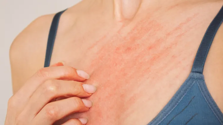 水痘传染力极高。水痘示意图