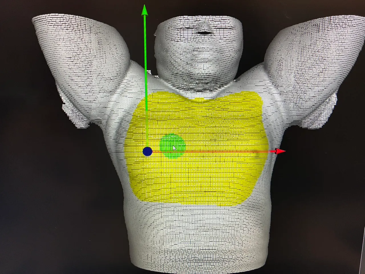 锐视刀搭配使用适应性放射治疗，疗程前会先接受电脑断层模拟定位影像扫描。童综合医院提供