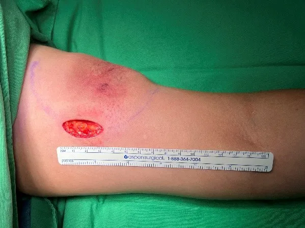 經以三公分的細小切口，精準分離並完整取出巨大脂肪瘤。亞大附醫提供