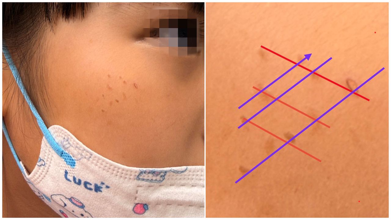 女童臉冒紅疹「排成格子狀」 醫揪出元兇:換掉它才會好