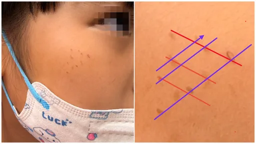 女童脸冒红疹「排成格子状」　医揪出元凶：换掉它才会好