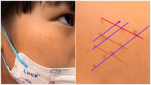 女童脸冒红疹「排成格子状」　医揪出元凶：要换掉它才会好