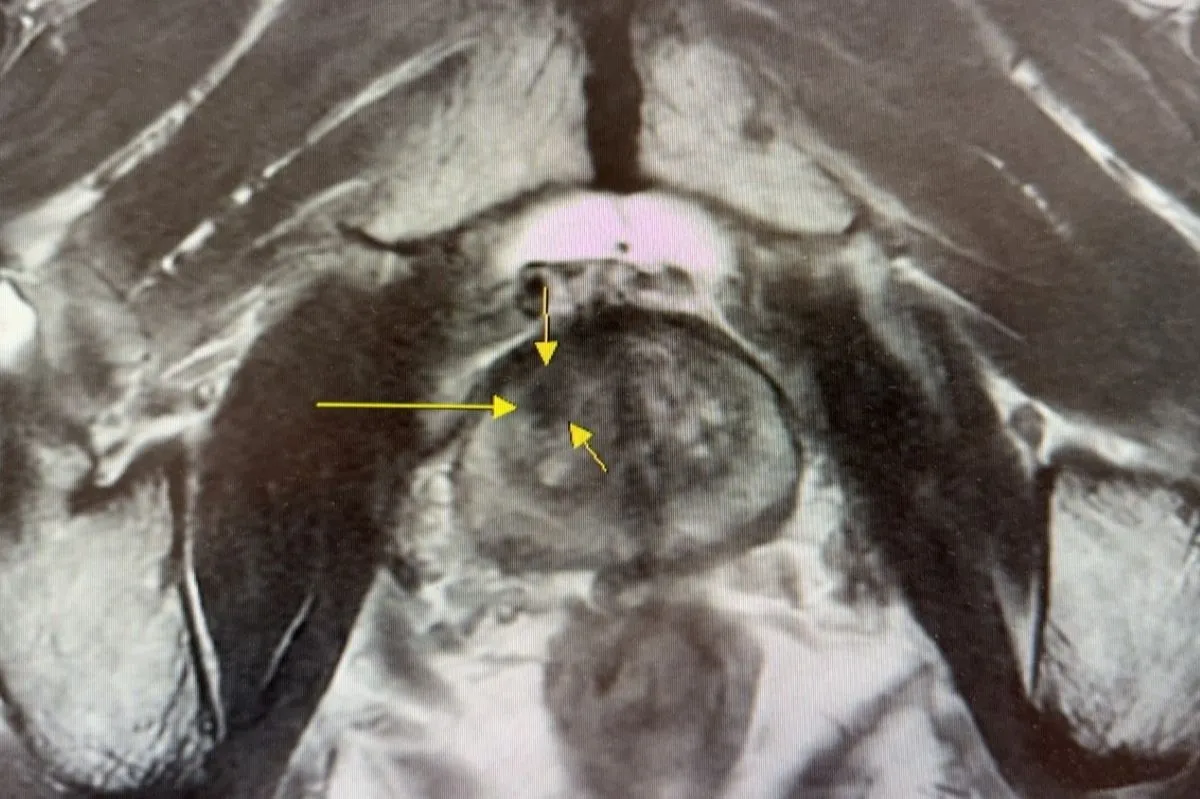 排尿异常别轻忽　台北慈济助攻早期揪出摄护腺癌