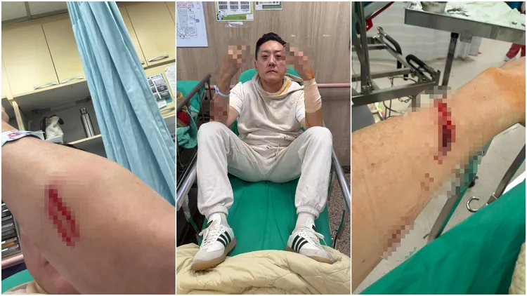「夜店大亨」夏天倫遭砍後曬出幾張傷勢照。翻攝《@hsia_alan》Threads