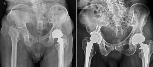 老翁跌倒1年后变长短脚差4公分　就医惊见「关节满是碎骨」