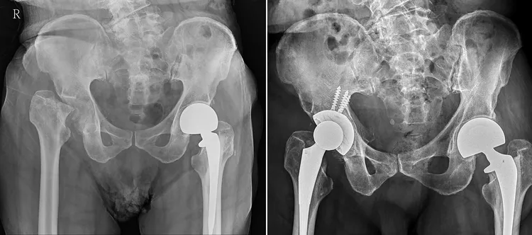 老翁跌倒后右侧髋关节碎裂（左图），1年后变长短脚差4公分，右图为术后置换人工关节。中港澄清提供