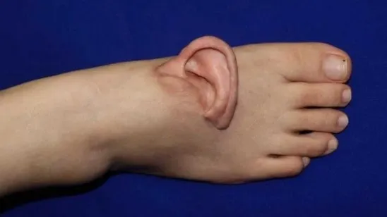 一名女子的左耳被扯断，医学团队决定将左耳「寄养」在她的脚背上。翻摄香港01