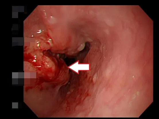 王先生食道癌病灶位置。亞大附醫提供