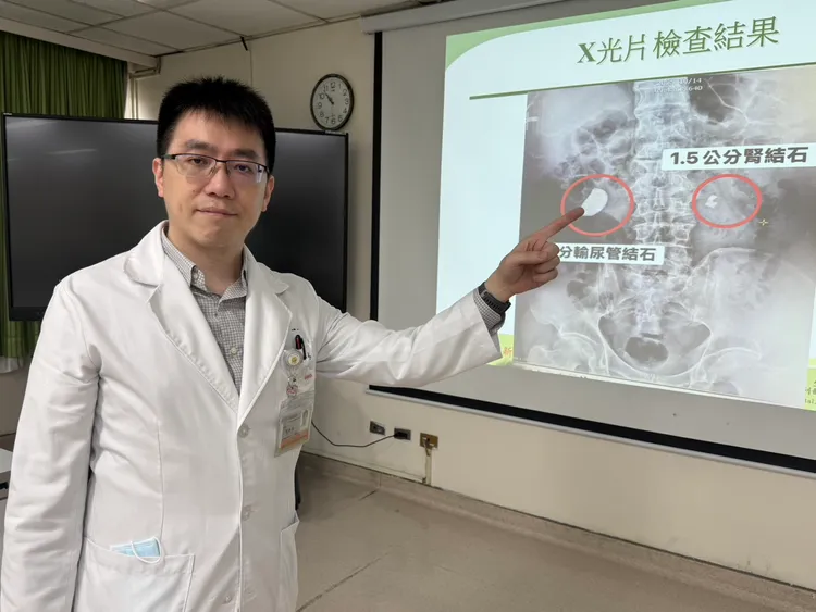 簡維宏醫師表示，管徑約0.5公分的輸尿管出現4公分巨大結石個案相當少見，幸好經過手術順利取出。台中醫院提供