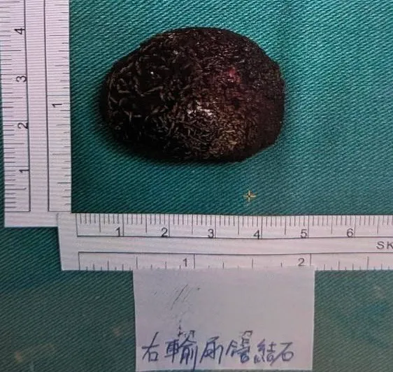 每周3次爬山健身竟血尿！輸尿管卡4cm結石　醫曝可能原因