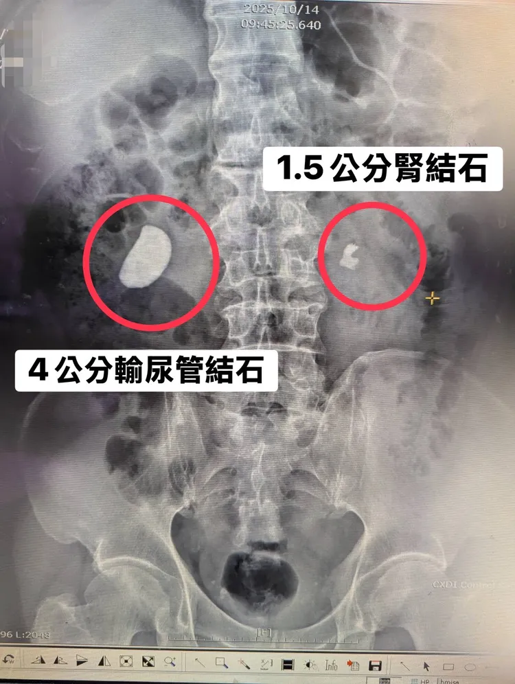 張先生因為腰酸腰痛合併血尿就醫，X光檢查發現右輸尿管跟左腎各有一顆巨大結石。台中醫院提供