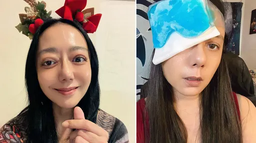 高慧君严重斜视甲状腺害的第3次开刀！勇敢po照正视大小眼问题