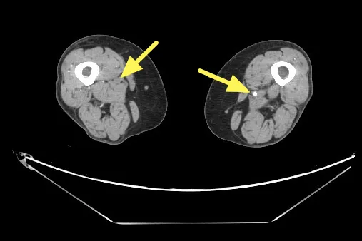 電腦斷層血管攝影顯示右股動脈脈阻塞。聯新醫院提供