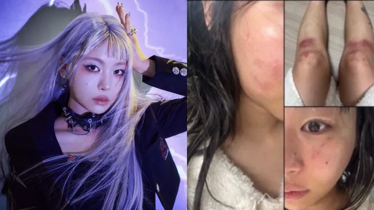 韩国女歌手Jvcki Wai公开伤势，控诉遭制作人前男友Vangdale施暴。翻摄AOMG、Jvcki Wai IG