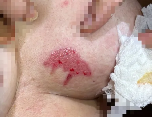 天冷禦寒暖暖包放「這裡」9小時　台中婦胸口現紅班竟燙傷