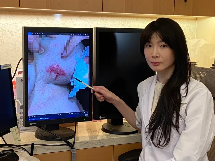 茂盛醫院皮膚科醫師鍾佩宜，最好選則溫度較低的貼膚性暖暖包，避免燙傷。院方提供