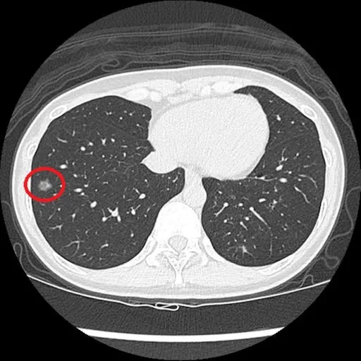沒症狀也中鏢！41歲女做公費電腦斷層　揪出肺癌一期