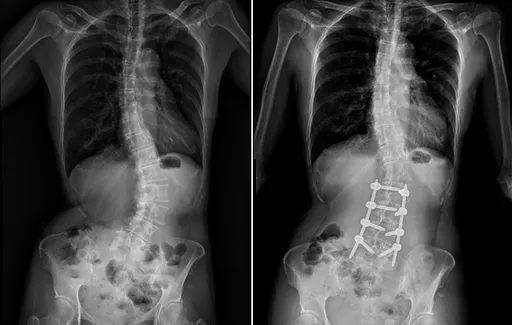 脊椎側彎25年動矯正手術　55歲婦長高5公分