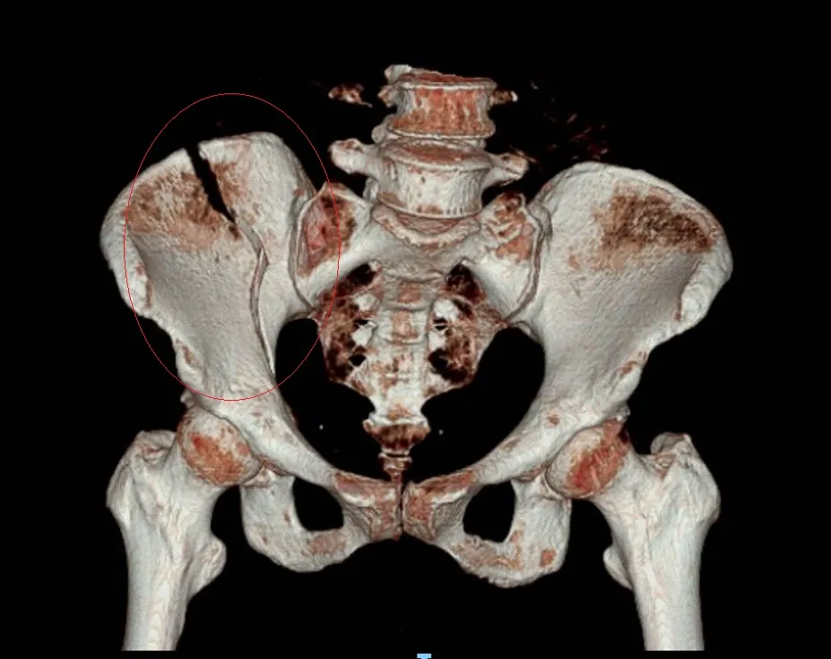骨盆斷裂。彰化醫院提供