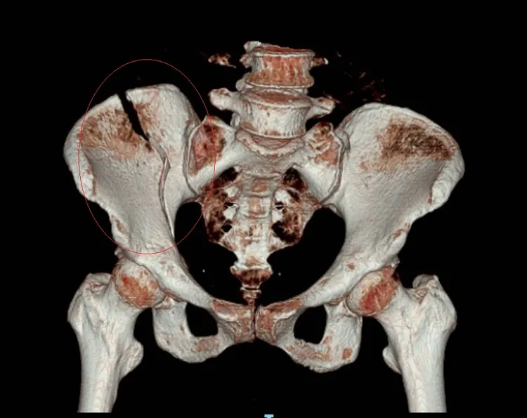骨盆斷裂。彰化醫院提供
