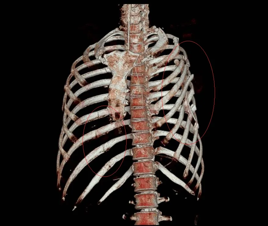 3D影像顯示肋骨多處斷裂。彰化醫院提供