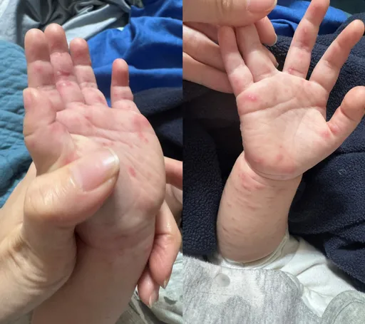 高雄小學腸病毒群聚14人中招　姊弟染疫還隱瞞家長怒批「沒公德心」