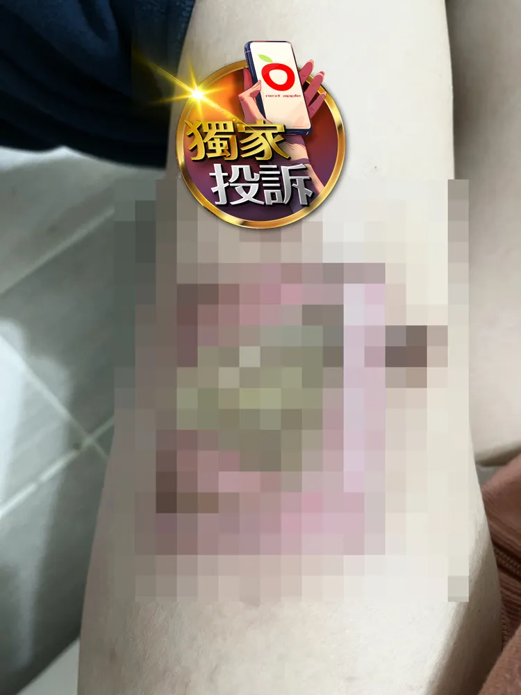 靠植皮手術才能縫合傷口。投訴人廖女提供