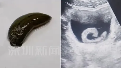 5cm活水蛭「塞入尿道」剧痛急求医　23岁男：网路偏方说有奇特效果