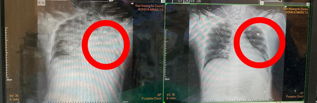 患者在家中喝珍奶突剧烈呛咳，呼吸困难送医时，双侧肺部出现大片浸润影，显示已处于严重缺氧状态。丰原医院提供