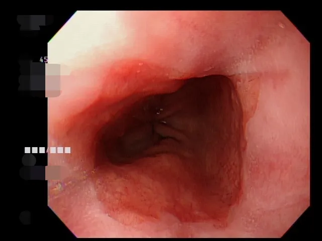 許姓業就醫後診斷為「夜間型胃食道逆流」。亞大附醫提供
