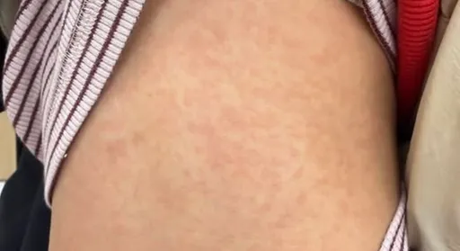 紅疹病童暴增！　醫師示警「這類衣服」是元兇