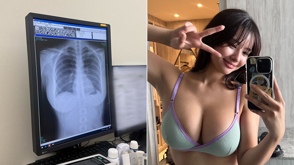 寫真偶像X光照讓網友暴動 一句「肺很乾淨」吸3100萬瀏覽