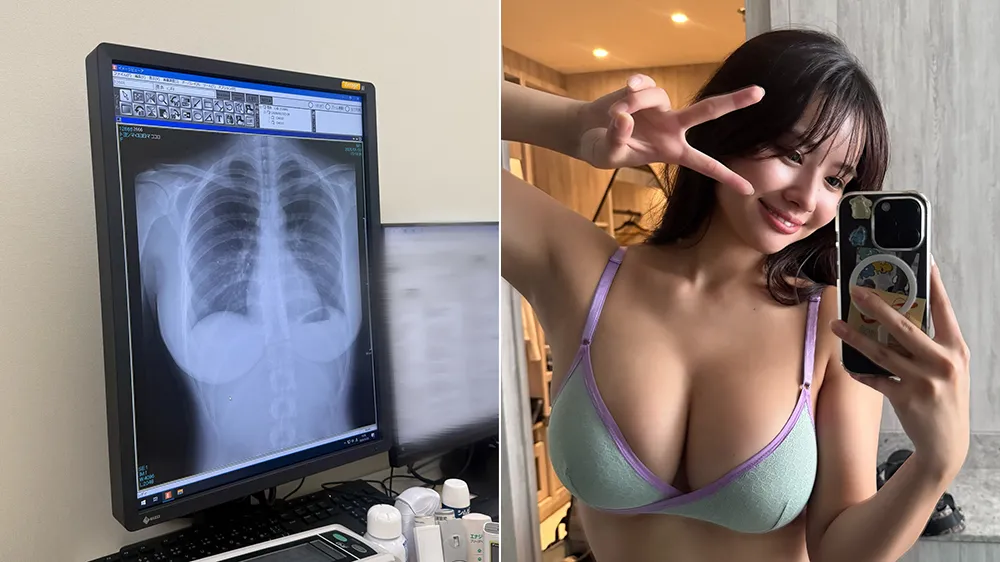 寫真偶像X光照讓網友暴動　一句「肺很乾淨」吸3100萬瀏覽