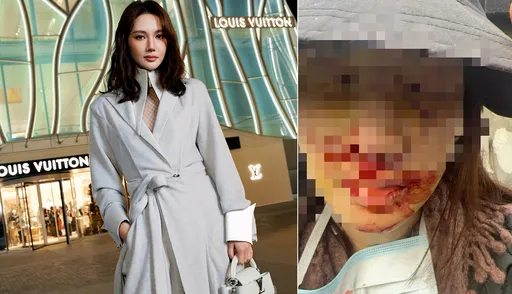 金晨車禍滿臉血慘樣曝光！動手術失去意識　還原助理頂包真相