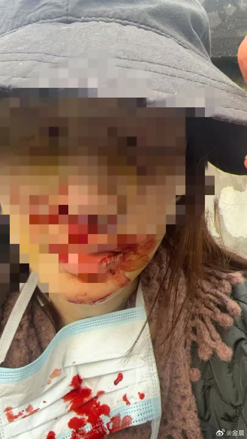 金晨po出滿臉是血照片做證據。翻攝金晨微博