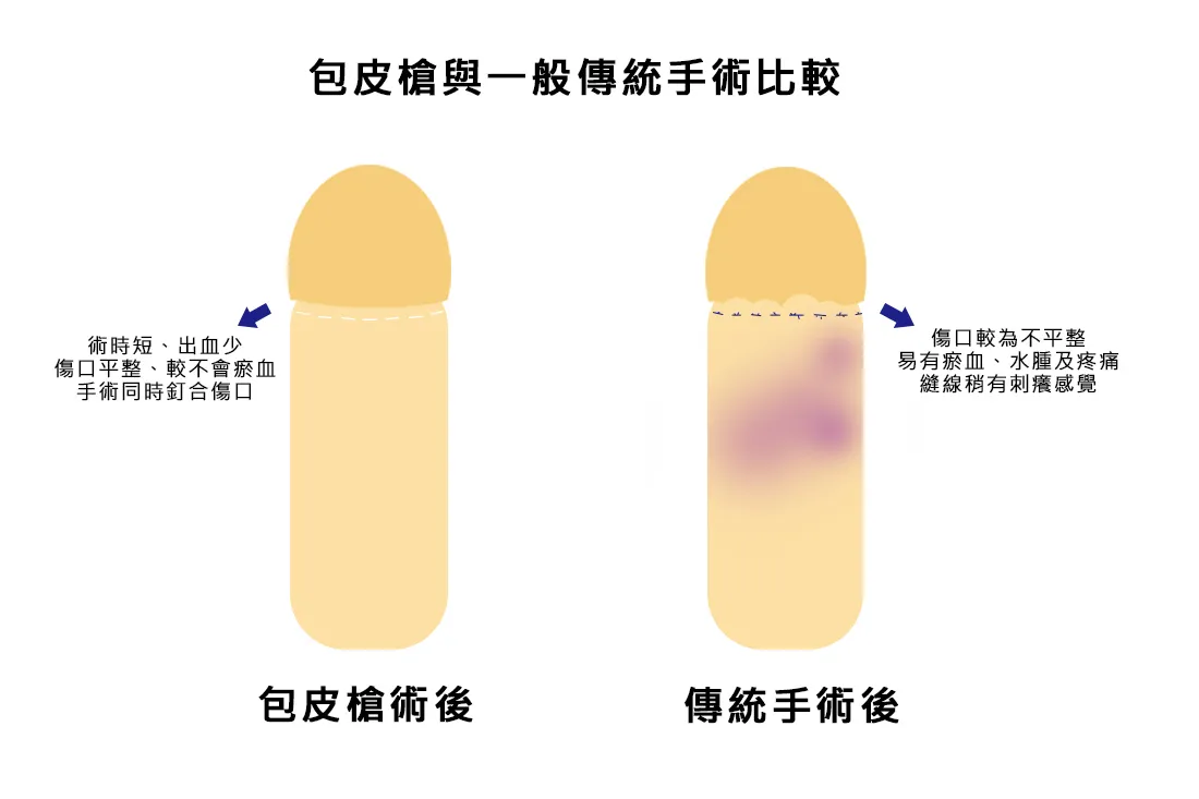 微創包皮槍手術時間快（約5–10分鐘）、切口平整美觀、術後腫脹輕、出血少。台中澄清醫院提供