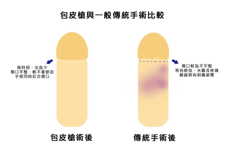微創包皮槍手術時間快（約5–10分鐘）、切口平整美觀、術後腫脹輕、出血少。台中澄清醫院提供