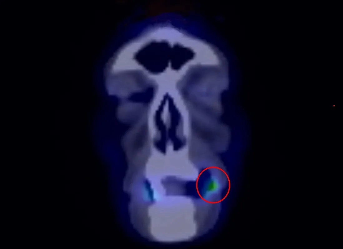 黃先生左側臉頰黏膜已有約2×1.5公分腫瘤（圓圈處），經檢查證實確診第二期口腔癌。光田醫院提供