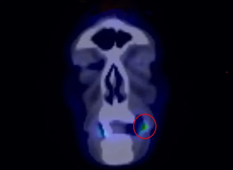黃先生左側臉頰黏膜已有約2×1.5公分腫瘤（圓圈處），經檢查證實確診第二期口腔癌。光田醫院提供