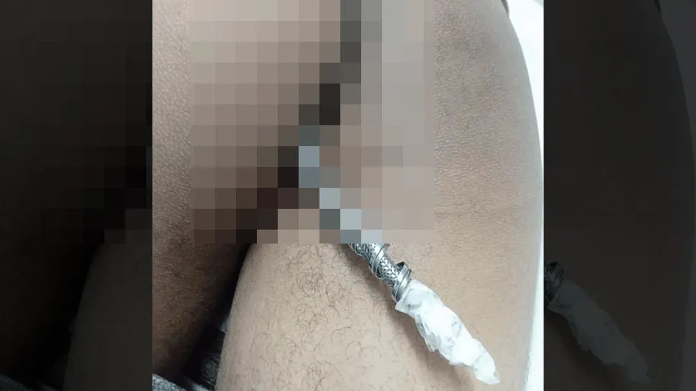 23歲男子連著部分水管到醫院求助。翻攝畫面