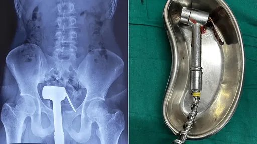 23歲男「淋浴器爆菊」卡住了　屁屁連著水管尾巴向醫師求救