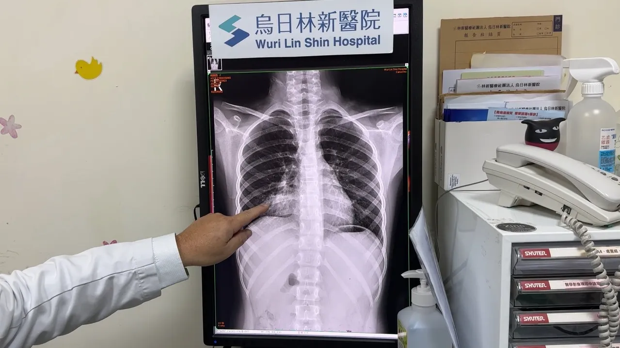 賴永清醫師提醒，罹患A型流感後若咳嗽持續超過2至3週，或再度出現高燒、胸痛、呼吸不適等症狀，應及早就醫檢查。烏日林新醫院提供
