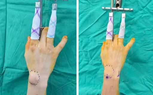 長期握滑鼠手背驚見「半顆乒乓球」　醫曝高風險「4大職業」