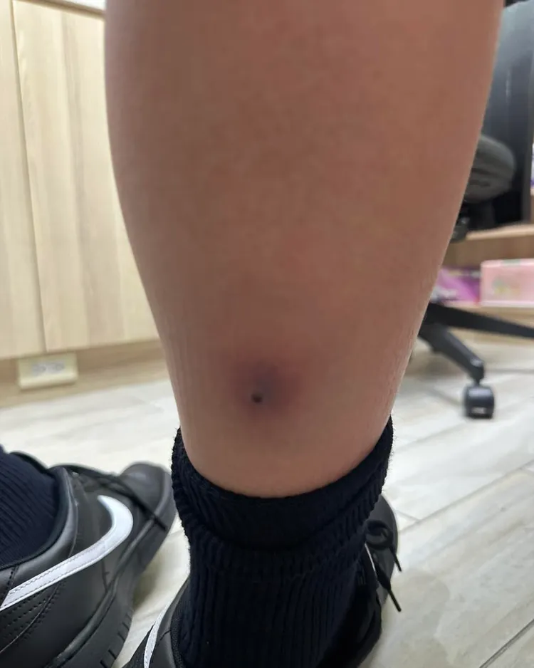 男孩腳疼痛紅腫送急診，懷疑是「毒性休克症候群」。旭恩小兒科診所」授權提供