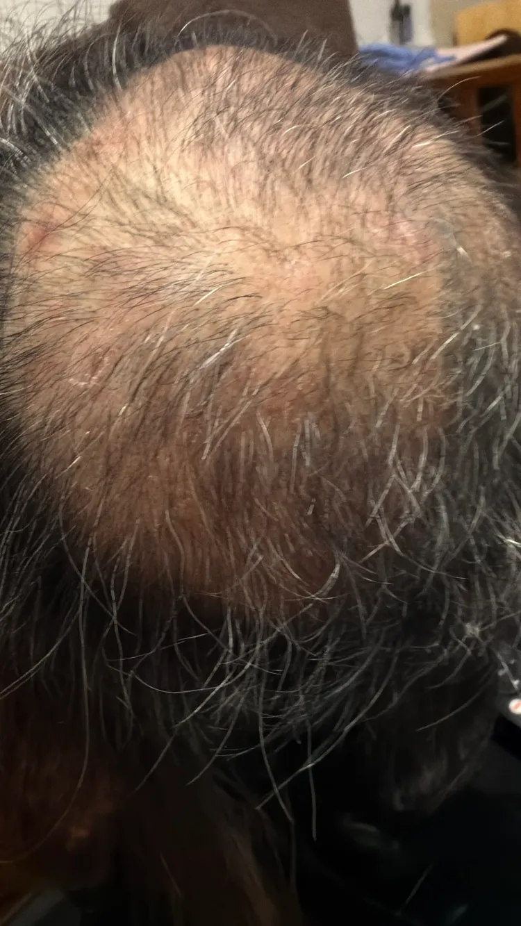 女住戶曝近況，表示頭髮有長出來了。翻攝Threads