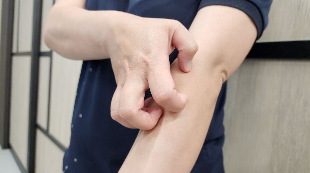 新北爆本土麻疹!42歲男確診 匡列526人監測